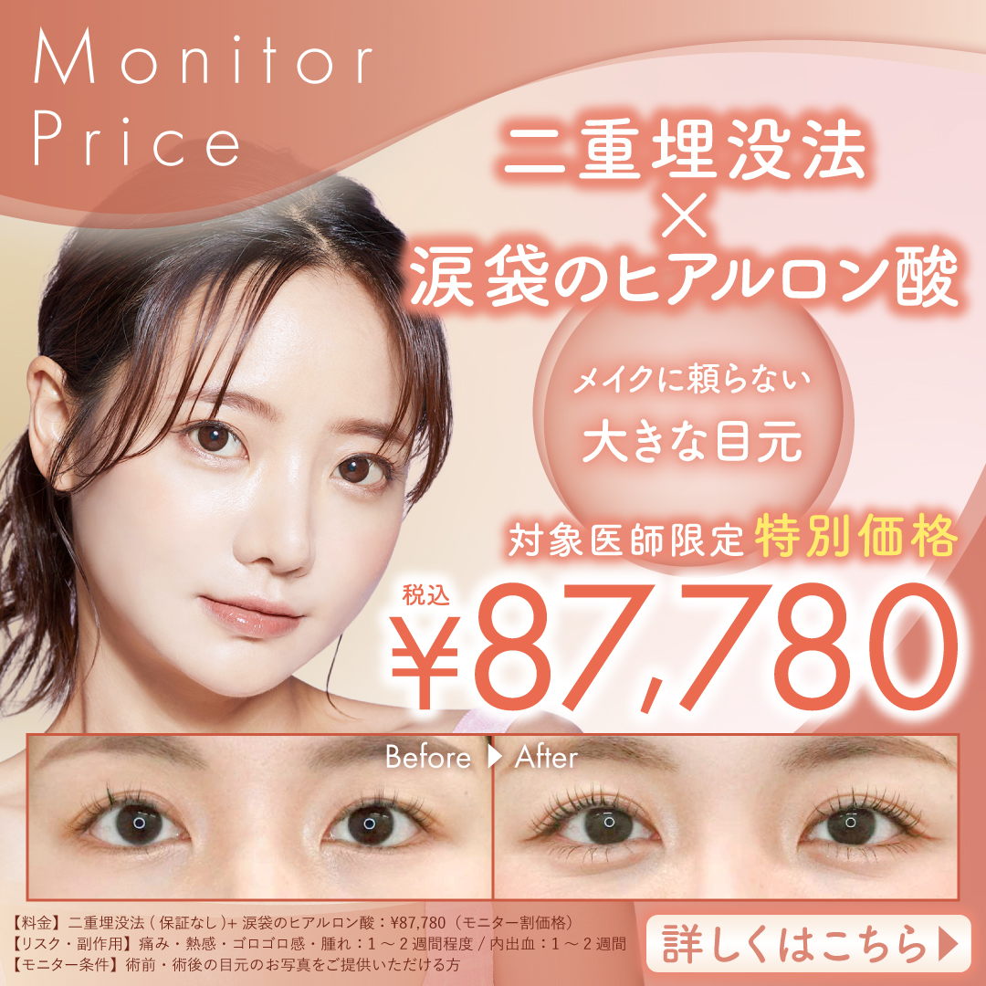 二重埋没法+涙袋のヒアルロン酸
